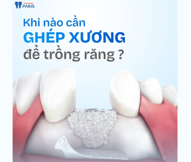 Không phải ai mất răng cũng có thể trồng Implant ngay lập tức.