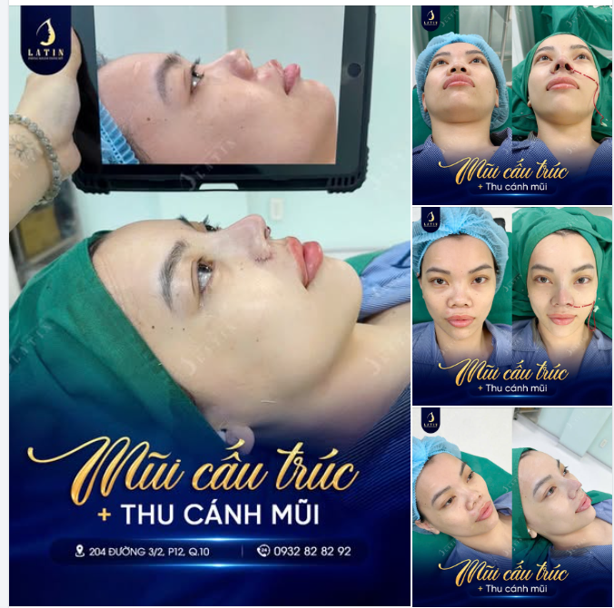 MŨI CẤU TRÚC VÀ THU CÁNH MŨI – GIẢI PHÁP CHO DÁNG MŨI HÀI HÒA, TỰ NHIÊN