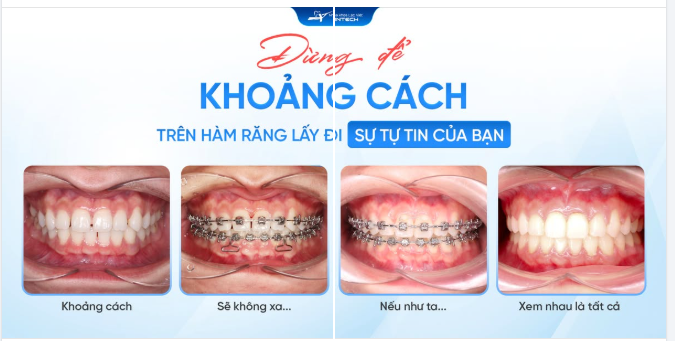 KHÉP LẠI KHOẢNG TRỐNG - MỞ RA NỤ CƯỜI NHỜ NIỀNG RĂNG X-MATRIX