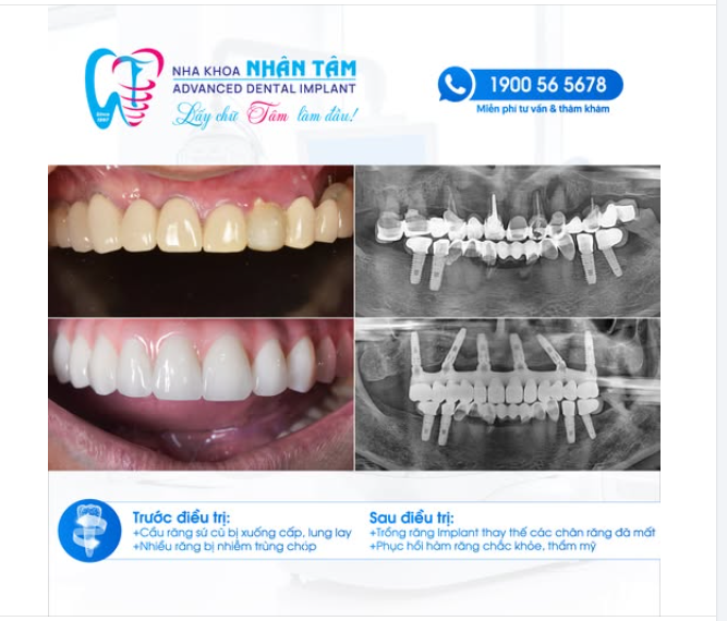 NHƯ THẾ NÀO LÀ MỘT HÀM RĂNG ĐẸP?