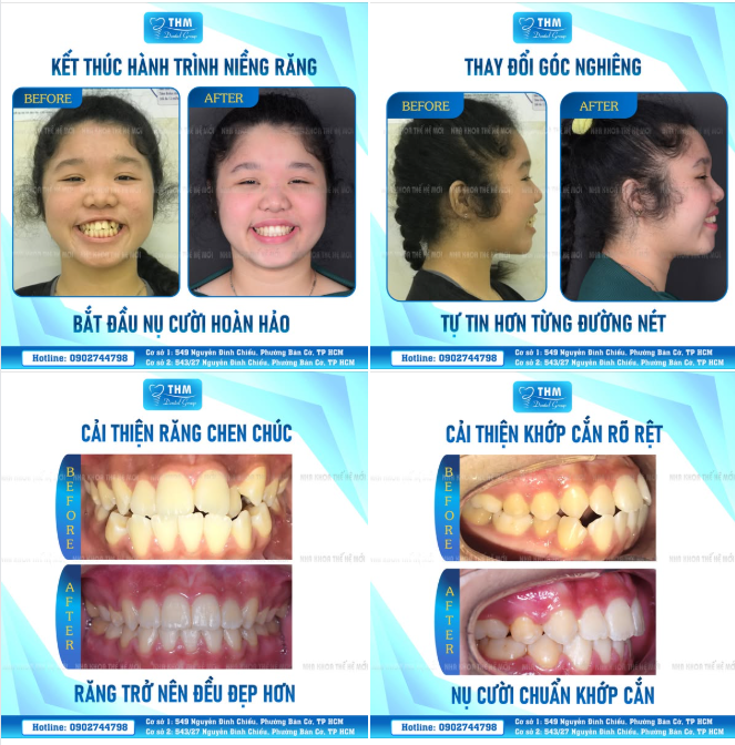KIM THOẠI – HÀNH TRÌNH NIỀNG RĂNG KHÉP LẠI, NỤ CƯỜI MỚI BẮT ĐẦU