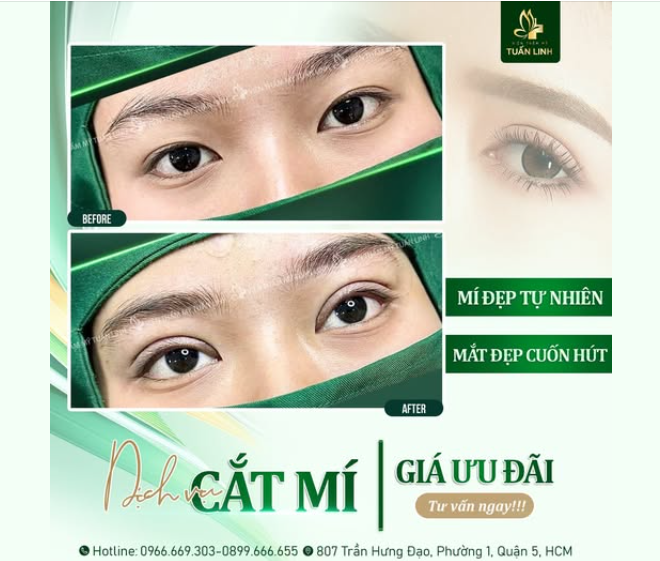 CẮT MÍ – "F5" CỬA SỔ TÂM HỒN, TRẺ HƠN 10 TUỔI!