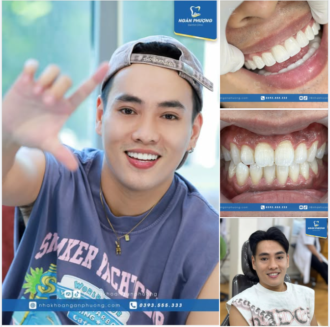 Màu sắc răng sứ tự nhiên