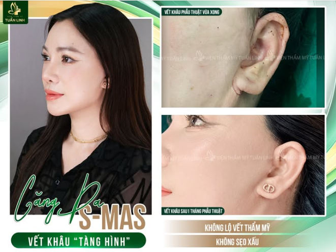 Sẽ có 2 loại là căng da Smas toàn phần và căng da Smas bán phần, tùy tình trạng sẽ được tư vấn phương pháp phù hợp nha.