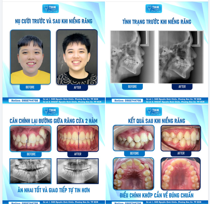 KHÔI NGUYÊN – HÀNH TRÌNH NIỀNG RĂNG 2.5 NĂM CHO MỘT NỤ CƯỜI TRỌN VẸN