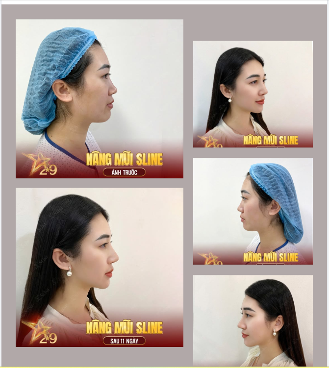 NÂNG MŨI SLINE – ĐƯỜNG CONG MỀM MẠI, THANH THOÁT