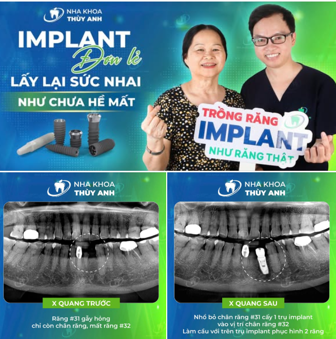 MẤT 2 RĂNG - CHỈ CẦN 1 TRỤ IMPLANT, VẪN CÓ THỂ LẤY LẠI NỤ CƯỜI TRỌN VẸN