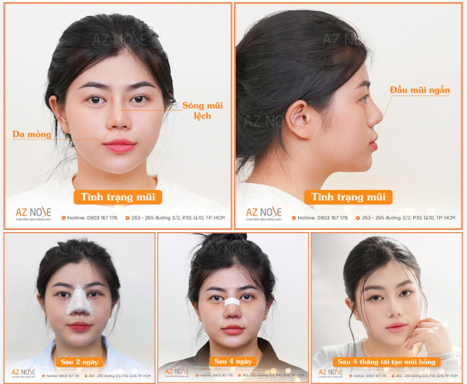 Khắc phục mũi l..ệch cho Gen Z ở Đồng Nai
