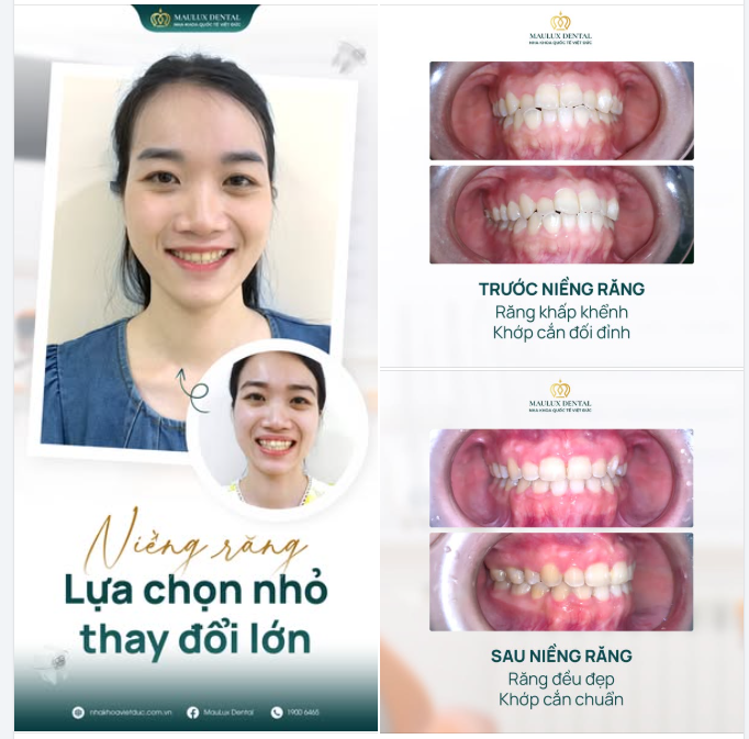 26 THÁNG KIÊN TRÌ – HÀNH TRÌNH LẤY LẠI NỤ CƯỜI RẠNG RỠ CỦA BÍCH NGỌC