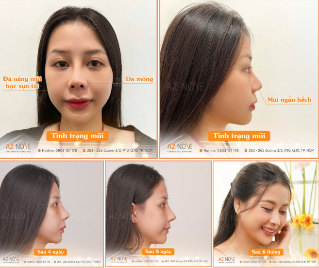 Khắc phục mũi ngắn, hếch cho Top 50 Miss Grand Vietnam 2022