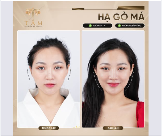 "Mọi người thường nhận xét gò má mình cao, khiến gương mặt trông đứng tuổi hơn so với tuổi thật" Chị Thuỷ tâm sự.