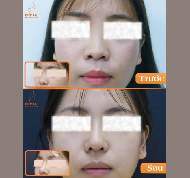THAY ĐỔI DIỆN MẠO VỚI DÁNG MŨI HÀI HÒA, TỰ NHIÊN
