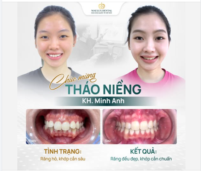 Tạm biệt răng hô - Hello nụ cười tự tin!