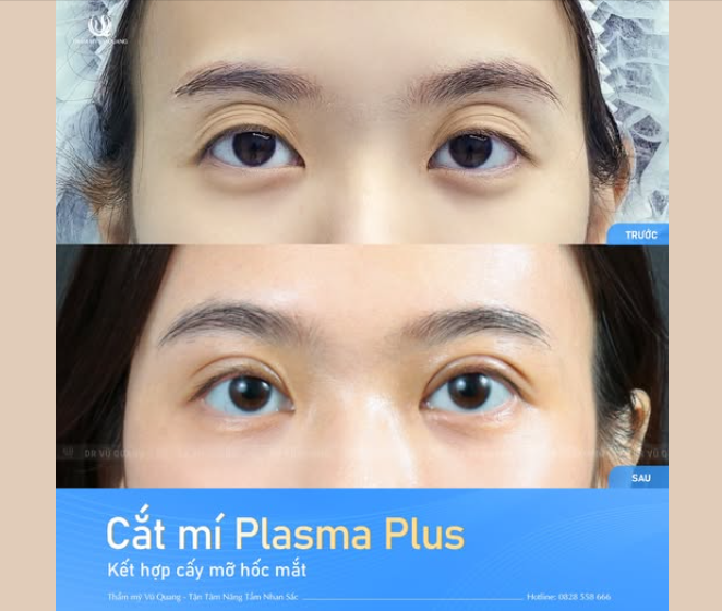 TẠO HÌNH THẨM MỸ MẮT....CHỈ VỚI 3 TRIỆU
