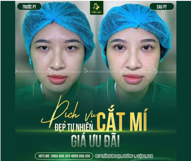 CẮT MÍ – ĐÔI MẮT TO TRÒN, RẠNG RỠ ÁNH NHÌN!!