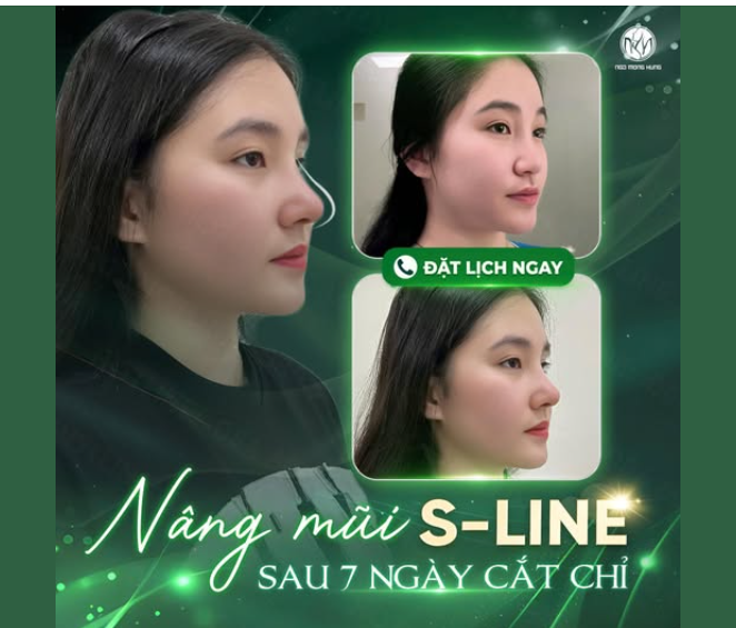 Hôm nay cắt chỉ, tháo nẹp, tranh thủ trước khi ra về chụp lại vài tấm ảnh cho Bác sĩ lan toả đến chị em đang có dự định nâng mũi