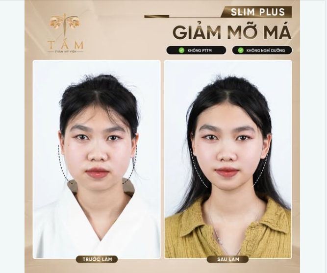 Giải pháp xoá tan mỡ má mà không cần phẫu thuật?