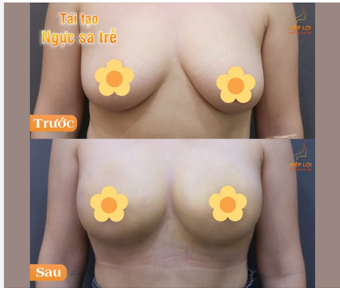 TÁI TẠO NGỰC SA SỄ LẤY LẠI SỰ TỰ TIN