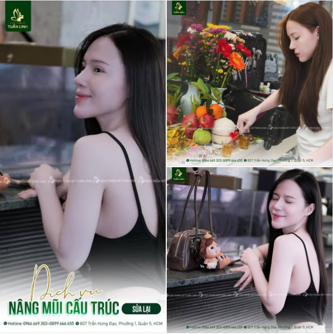 NÂNG MŨI CẤU TRÚC SỬA LẠI – LẤY LẠI SỰ TỰ TIN, ĐẸP TỪNG GÓC NHÌN!!