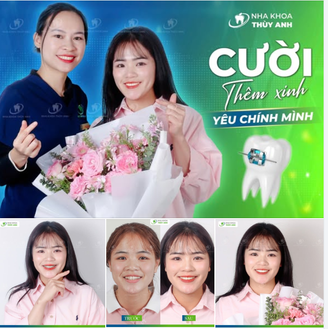 TẠM BIỆT RĂNG HÔ - CHÀO NỤ CƯỜI RẠNG RỠ