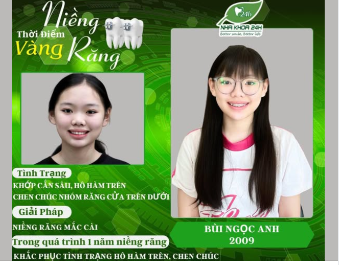 Niềng Răng – Đầu Tư Thông Minh Cho Tương Lai Nụ Cười
