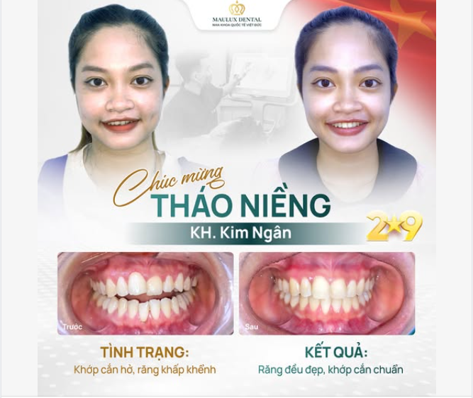 MỪNG NGÀY THÁO NIỀNG: KHÁCH HÀNG VÕ THỊ KIM NGÂN