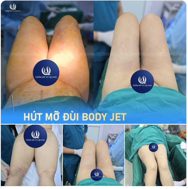 HÔ BIẾN “CHÂN VOI” CỘT ĐÌNH CHỈ SAU 90 PHÚT