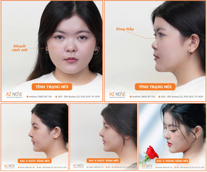 Diện mạo của Youtuber Tú Anh đã có bước chuyển mình thế nào sau 2 tháng nâng mũi