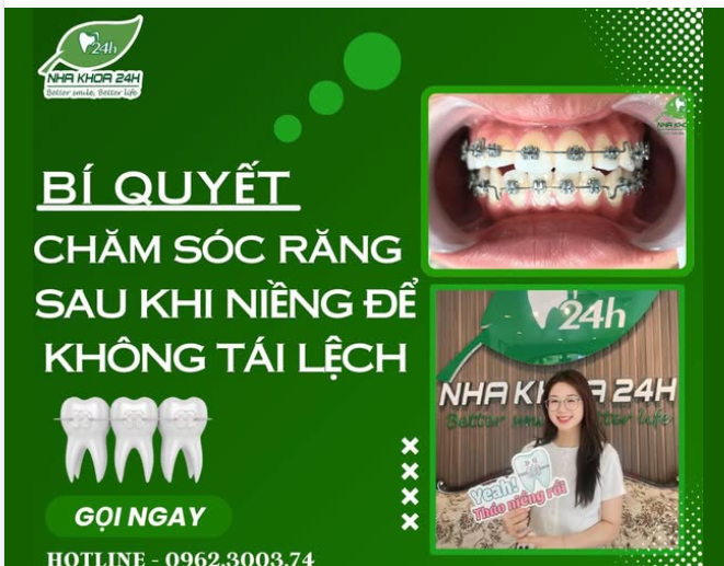 7 Bí Quyết Chăm Sóc Răng Sau Khi Niềng Để Không Tái Lệch