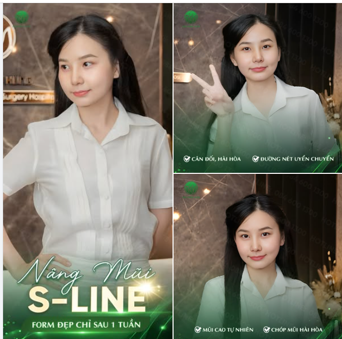 Nâng mũi S-Line – Form đẹp chỉ sau 1 tuần