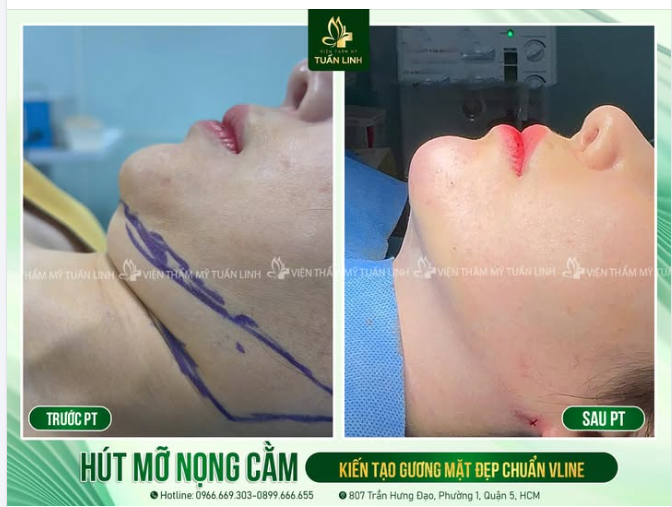 HÚT MỠ NỌNG CẰM – KIẾN TẠO GƯƠNG MẶT ĐẸP CHUẨN V-LINE!!