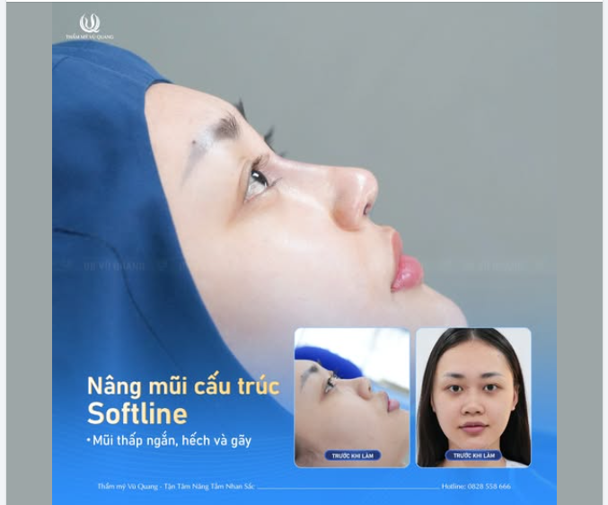 Chị đã có mặt tại Thẩm mỹ Vũ Quang, lấy lại sự tự tin cũng diện mạo mới, một phiên bản mới rực rỡ hơn, không còn nỗi lo mũi thấp tẹt, xấu xí nữa!