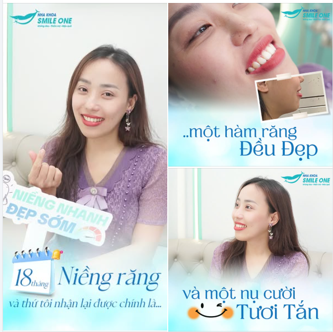 Chị chỉ hối hận vì đã không niềng răng sớm hơn, chứ không hối hận vì chọn nha khoa Smile One cho hành trình niềng tuyệt vời của mình.