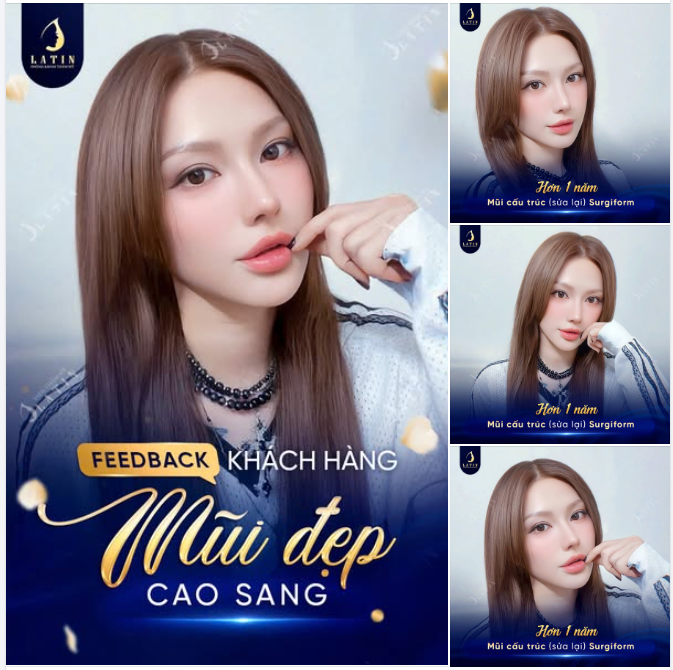 MŨI CẤU TRÚC SỬA LẠI SURGIFORM HƠN 1 NĂM - CÀNG NGÀY CÀNG THĂNG HẠNG