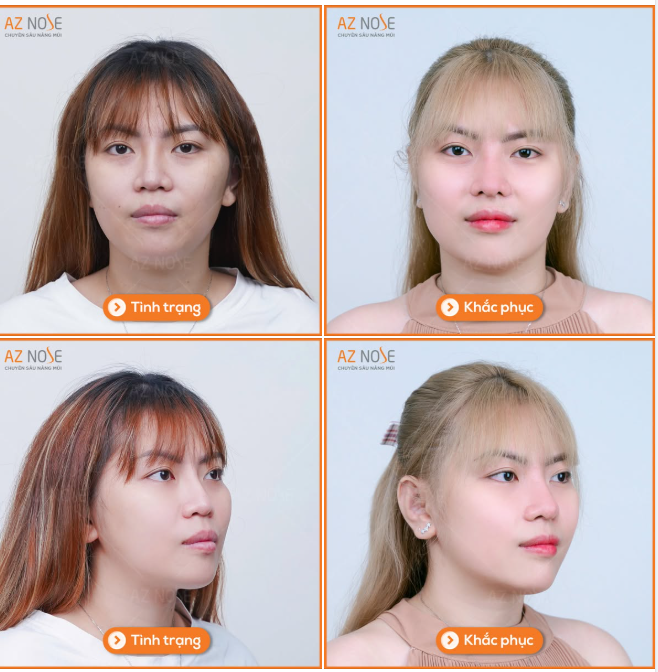 Khắc phục mũi cụp cho khách hàng 9X từng 2 lần nâng mũi hỏng