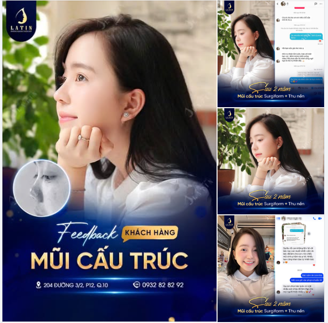 2 NĂM SAU NÂNG MŨI – MŨI ĐẸP NHƯ MƠ - HÓA NÀNG THƠ