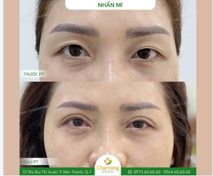 Phương pháp nhấn mí tạo nếp mí mới mà không cần cắt da, đường nhấn tự nhiên, hồi phục nhanh, phù hợp cho những ai muốn cải thiện mắt nhưng ngại xâm lấn.