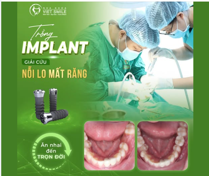 TRỒNG IMPLANT – GIẢI CỨU NỖI LO MẤT RĂNG