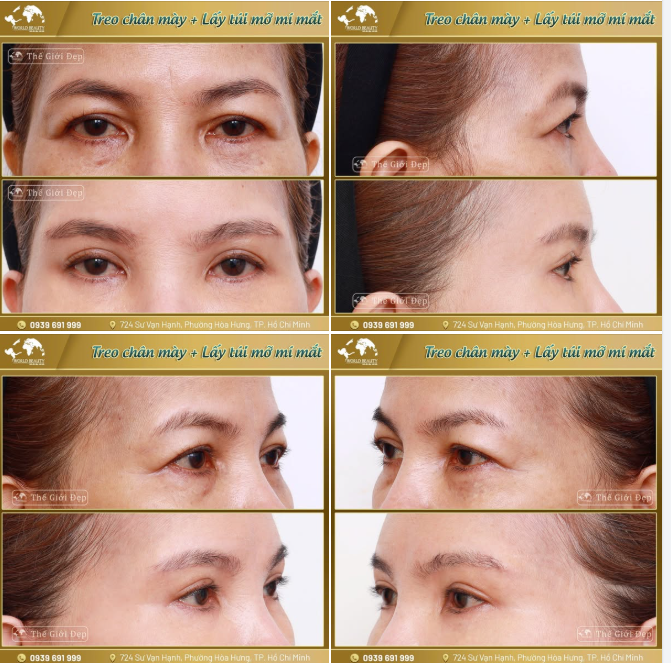 Khi bước qua ngưỡng trung niên, vùng mắt thường là nơi đầu tiên bộc lộ rõ dấu hiệu của thời gian.