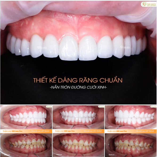 ĐỔI NỤ CƯỜI, ĐÓN TỰ TIN!