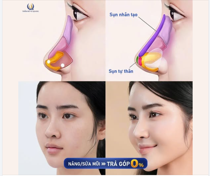 TẶNG NGAY 15 SUẤT NÂNG MŨI GIÁ GỐC – Ưu đãi siêu hời