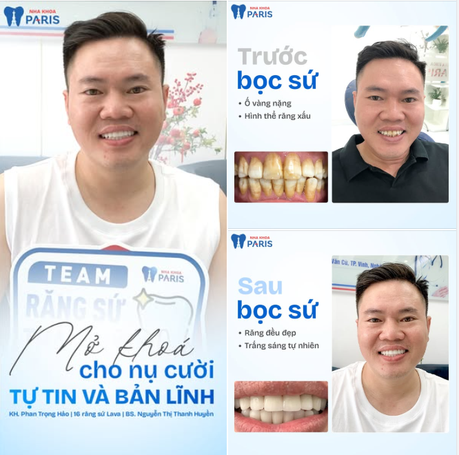 Khách hàng Phan Trọng Hảo đã lựa chọn phục hình 16 răng sứ Lava dưới sự thực hiện của BS Nguyễn Thị Thanh Huyền