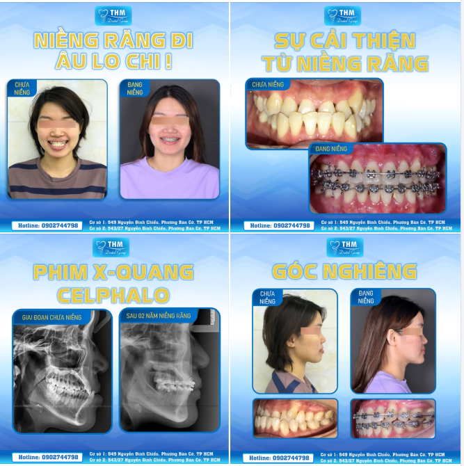 NIỀNG RĂNG - HƠN CẢ THAY ĐỔI NỤ CƯỜI