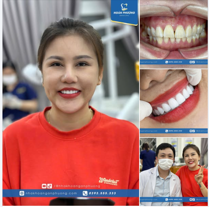 Bộ răng sứ hơn cả yêu, nụ cười mới hơn cả xinh đẹp