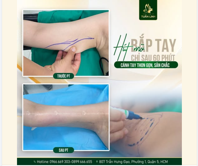 HÚT MỠ BẮP TAY - CÁNH TAY THON GỌN, ĐẸP NHANH, KHÔNG ĐAU, KHÔNG SẸO!!