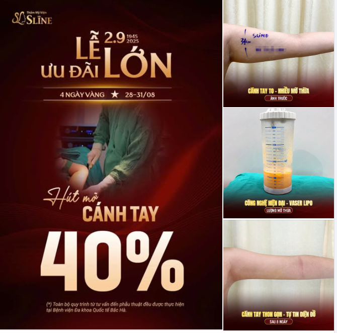 GIẢM NGAY 40% DỊCH VỤ HÚT MỠ CÁNH TAY