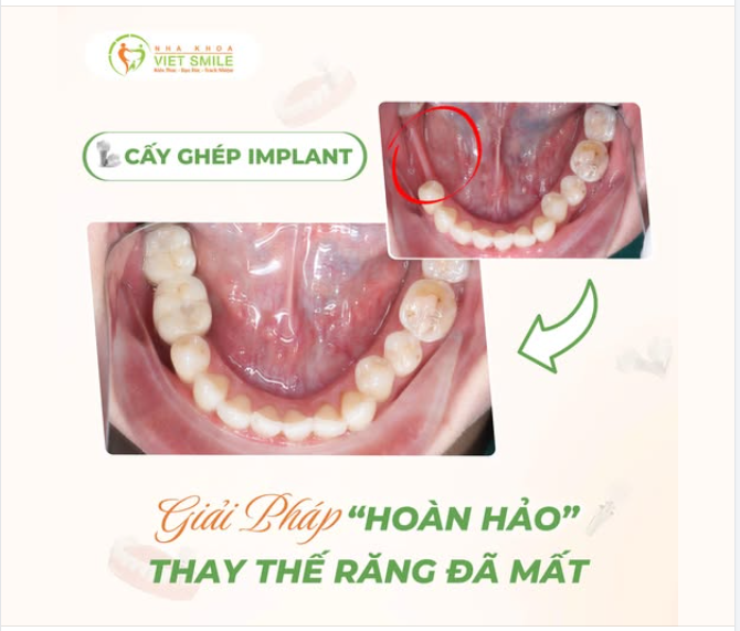 TRỒNG RĂNG IMPLANT – KHÔI PHỤC 2 RĂNG MẤT LIỀN KỀ