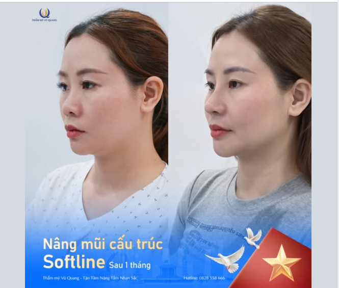 SAU 1 THÁNG NÂNG MŨI SOFTLINE SẼ NHƯ THẾ NÀO?