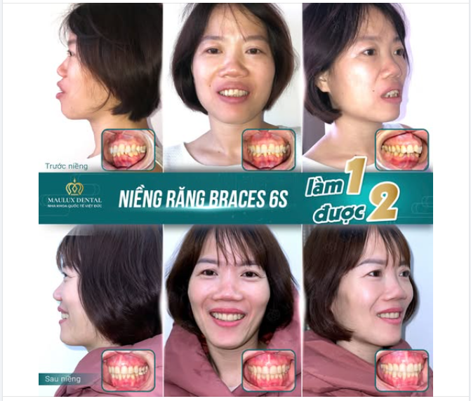 BÙI THỊ THU – TRẺ RA 10 TUỔI SAU KHI NIỀNG RĂNG