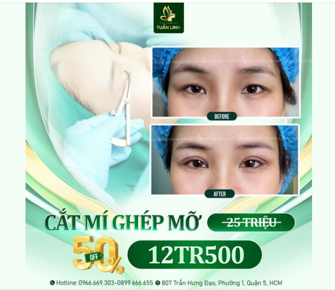 CẮT MÍ GHÉP MỠ - OFF TỚI 50% - CÒN  12TR500 ( gốc 25TR)